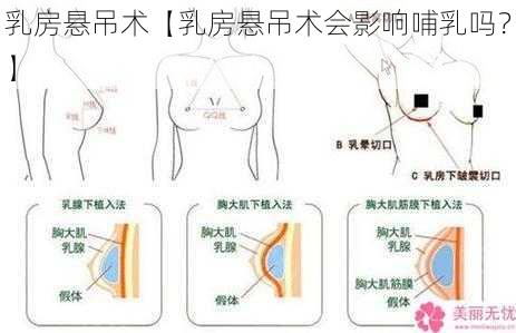 乳房悬吊术【乳房悬吊术会影响哺乳吗？】